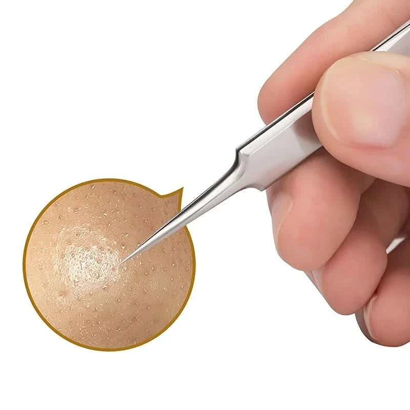 Fine Tip Stainless Steel Acne Clip, Acne Removal Tweezers, Facial Blackhead Extraction Facial Cleansing Skin Care Tools - M & M Global