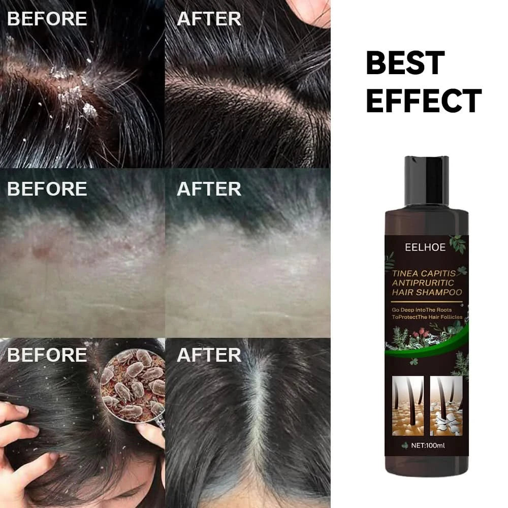 Hair Shampoo For Tinea Capitis Antipuriticprofessional Antidandruff Remove Mites Andrelieve Itching Shampoo 100ml Party Favours - M & M Global