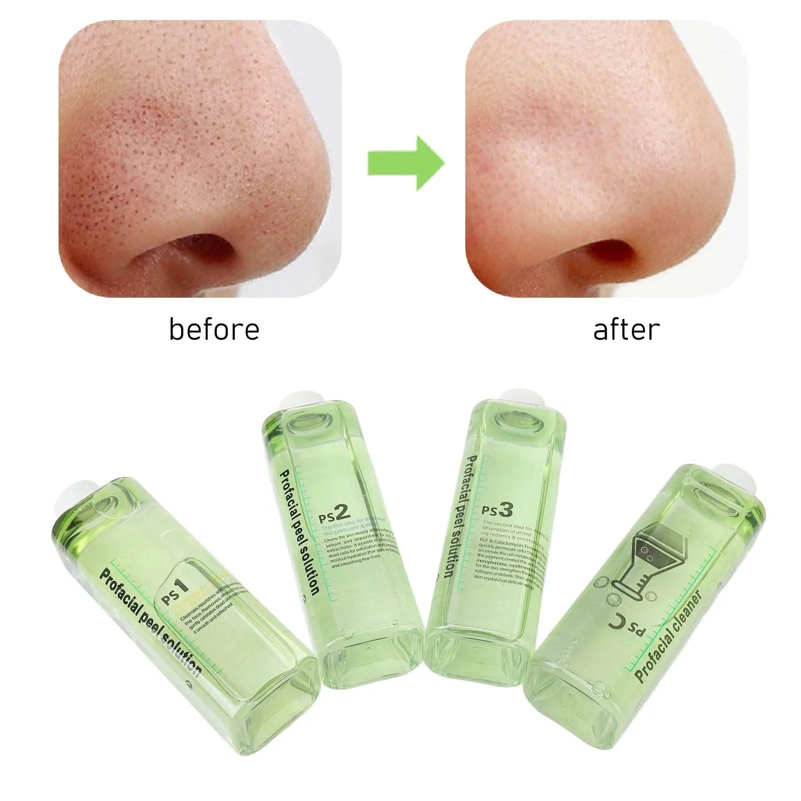 4pcs Hydra Peeling Facial Serum for Dermabrasion Machine Deep Cleansing Hydro Dermabrasion Solution Solution Serum - M & M Global