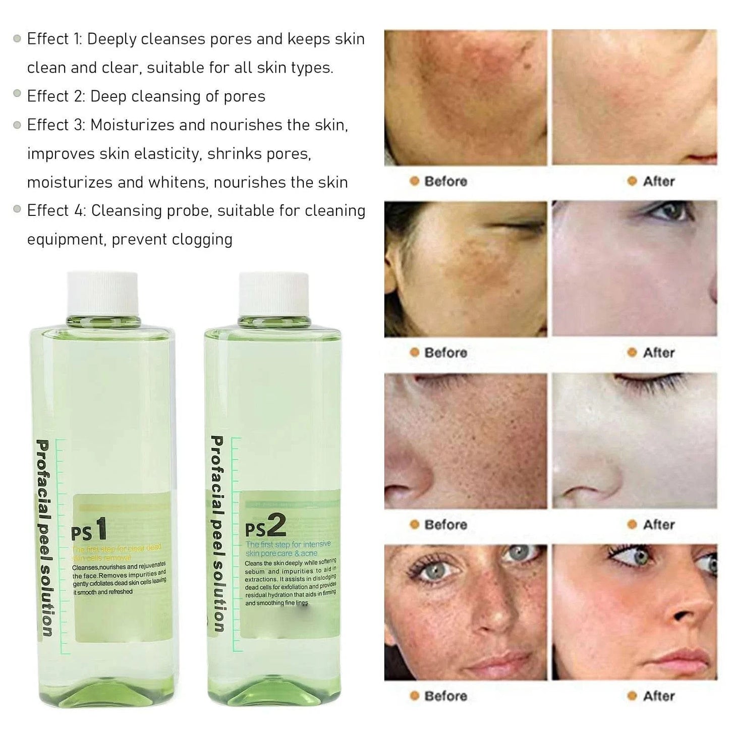 4pcs Hydra Peeling Facial Serum for Dermabrasion Machine Deep Cleansing Hydro Dermabrasion Solution Solution Serum - M & M Global
