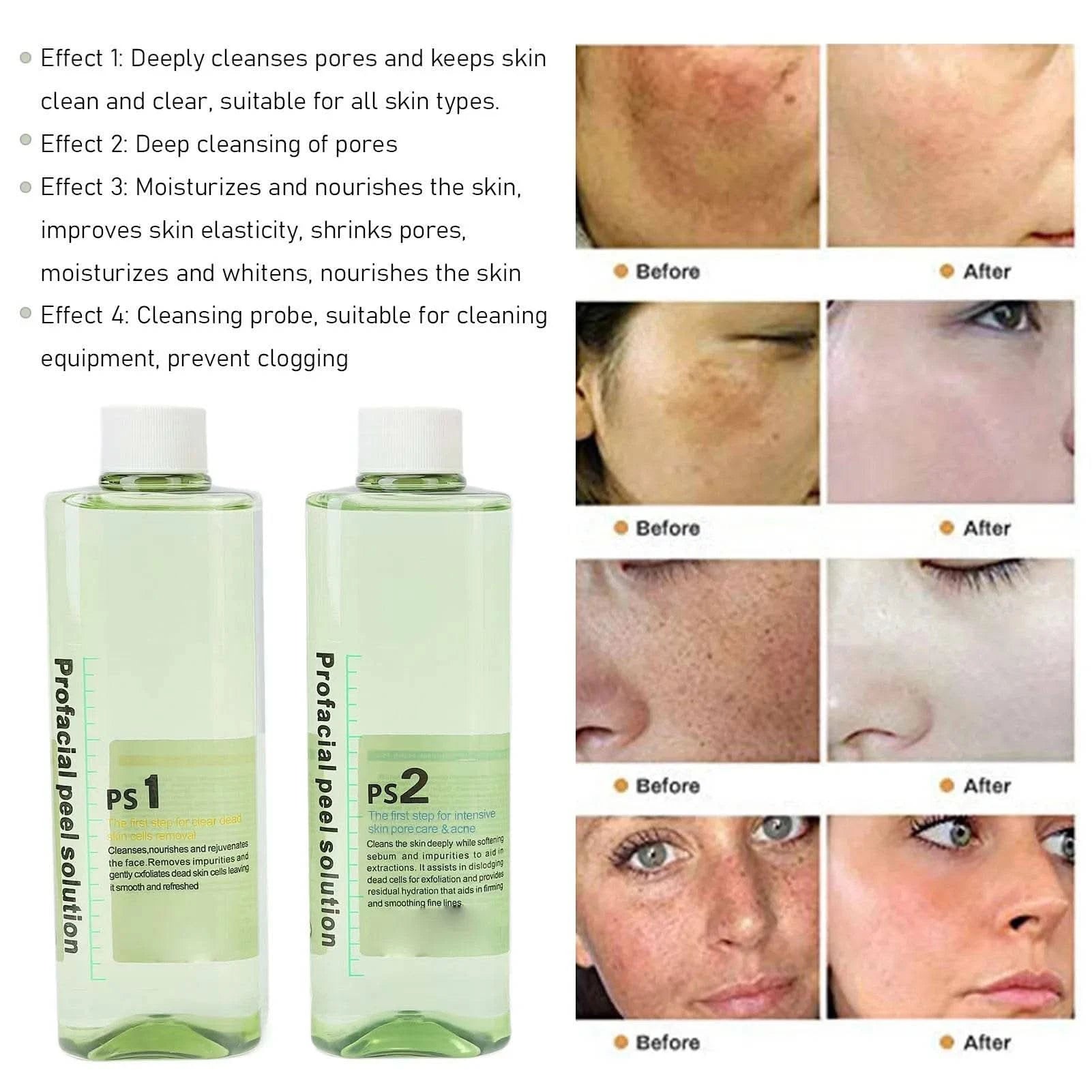 4pcs Hydra Peeling Facial Serum for Dermabrasion Machine Deep Cleansing Hydro Dermabrasion Solution Solution Serum - M & M Global