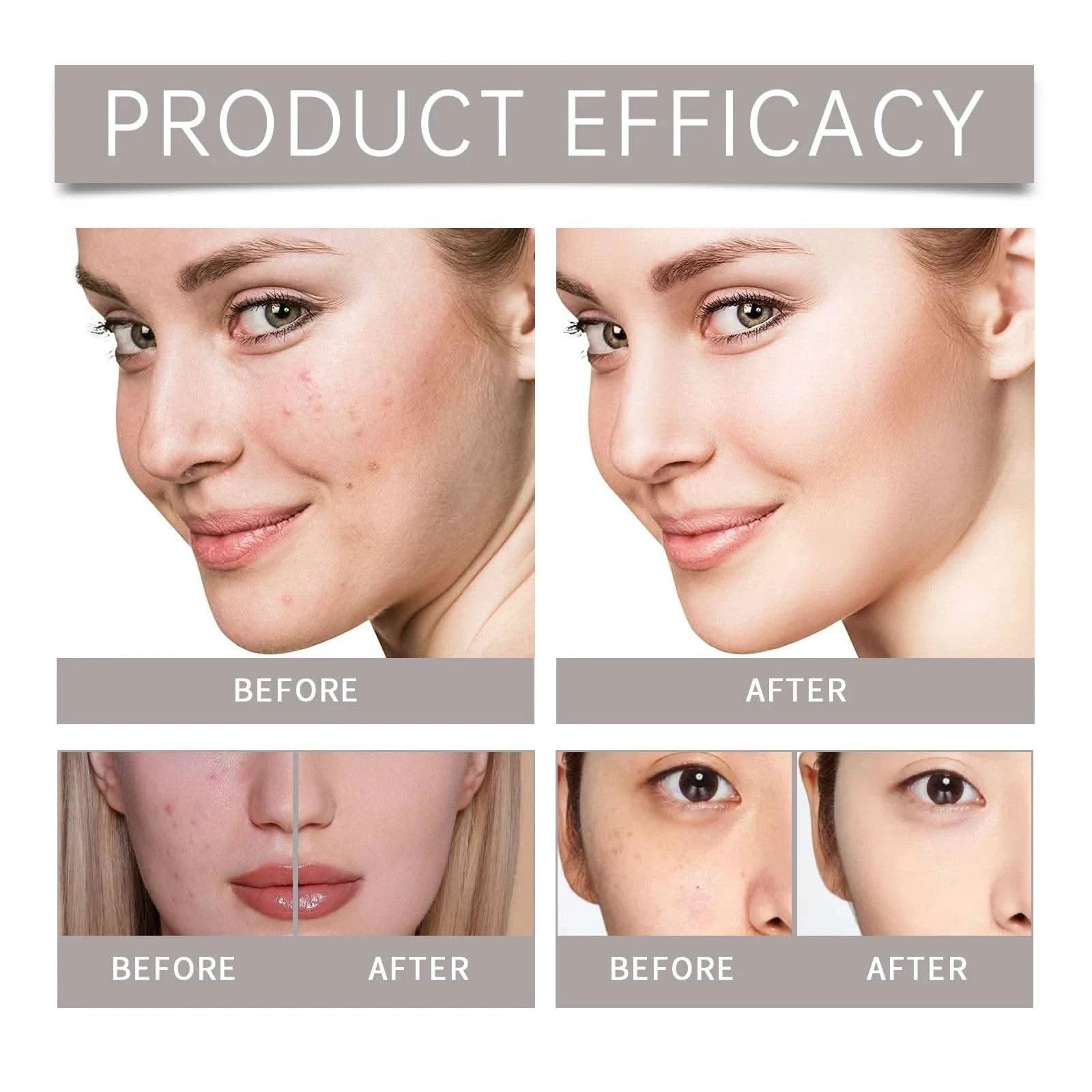 Acne Care Kit Brightening Skin Tone Fade Acne Scars Improving Skin Texture Deeply Moisturizing The Skin Facial Skincare Products - M & M Global
