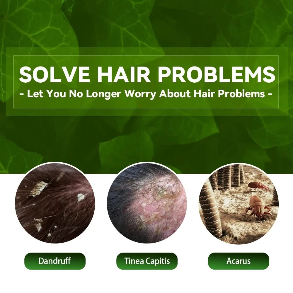 Hair Shampoo For Tinea Capitis Antipuriticprofessional Antidandruff Remove Mites Andrelieve Itching Shampoo 100ml Party Favours - M & M Global