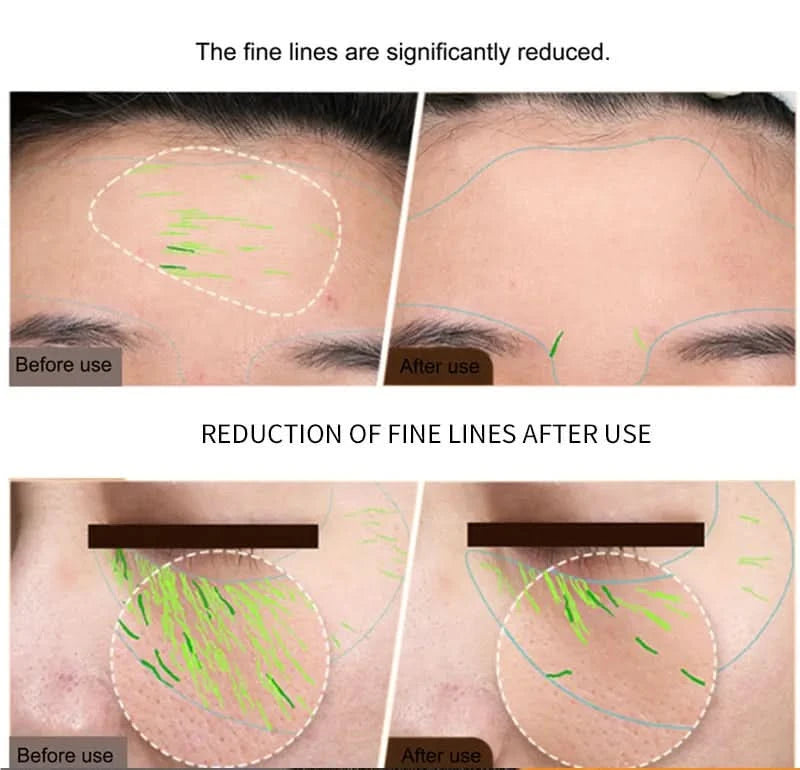 EMS Facial Body Radio Frequency Machine Skin Tightening Face Lifting RF Beauty Device Professional Home RF Skin Care Anti Aging - M & M Global